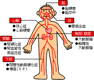 動脈 硬化 と は