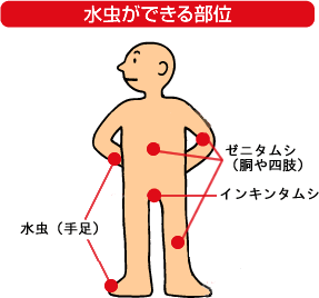 水虫ができる部位